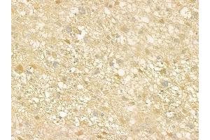 ABIN6261420 and ABIN6277672 at 1/100 staining human astrocytoma by IHC-P.