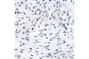 Immunohistochemistry of paraffin-embedded human esophageal cancer using TFE3 Rabbit mAb (ABIN1683323, ABIN3015205, ABIN3015206 and ABIN7101320) at dilution of 1:100 (40x lens). (TFE3 anticorps)