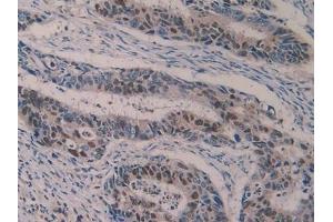 Detection of 5-LO in Human Colorectal cancer Tissue using Polyclonal Antibody to 5-Lipoxygenase (5-LO) (ALOX5 anticorps  (AA 461-671))