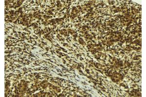 ABIN6272493 at 1/100 staining Human breast cancer tissue by IHC-P. (ZNF295 anticorps  (N-Term))