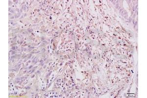 Formalin-fixed and paraffin embedded human gastric carcinoma labeled with Anti-Dnmt3a Polyclonal Antibody, Unconjugated (ABIN669336) at 1:200, followed by conjugation to the secondary antibody and DAB staining (DNMT3A anticorps  (AA 26-100))