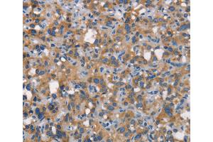 Immunohistochemistry (IHC) image for anti-Carcinoembryonic Antigen-Related Cell Adhesion Molecule 6 (CEACAM6) antibody (ABIN2432096) (CEACAM6 anticorps)