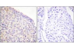 Immunohistochemistry analysis of paraffin-embedded human breast carcinoma, using SYK (Phospho-Tyr525) Antibody. (SYK anticorps  (pTyr525))