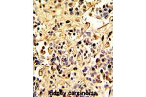 Formalin-fixed and paraffin-embedded human kidney carcinoma with Neprilysin Antibody (C-term), which was peroxidase-conjugated to the secondary antibody, followed by DAB staining.