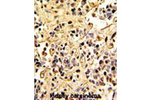 Formalin-fixed and paraffin-embedded human kidney carcinoma with Neprilysin Antibody (C-term), which was peroxidase-conjugated to the secondary antibody, followed by DAB staining. (MME anticorps  (C-Term))