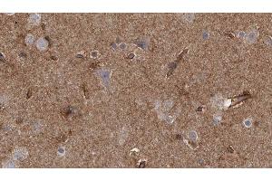 ABIN6277785 at 1/100 staining Human brain cancer tissue by IHC-P.