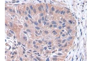 DAB staining on IHC-P; Samples: Human Lung cancer Tissue (pPLA2 anticorps  (AA 16-148))