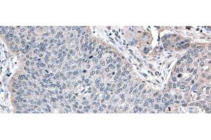 Immunohistochemistry of paraffin-embedded Human lung cancer tissue using ZFAND5 Polyclonal Antibody at dilution of 1:35(x200) (ZFAND5 anticorps)