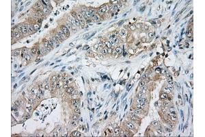 Immunohistochemical staining of paraffin-embedded Adenocarcinoma of Human ovary tissue using anti-CD5 mouse monoclonal antibody. (CD5 anticorps)
