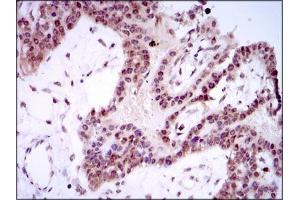 Immunohistochemical analysis of paraffin-embedded ovarian cancer tissues using SPIB mouse mAb with DAB staining.