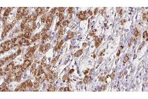 ABIN6278126 at 1/100 staining Human liver cancer tissue by IHC-P.