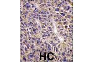 Formalin-fixed and paraffin-embedded human hepatocarcinoma reacted with UBE2L6 Antibody (N-term) (ABIN1882146 and ABIN2839155) , which was peroxidase-conjugated to the secondary antibody, followed by DAB staining.