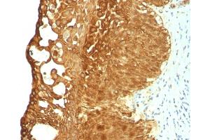 Formalin-fixed, paraffin-embedded human Cervical Carcinoma stained with Cytokeratin 19 Mouse Monoclonal Antibody (KRT19/799).