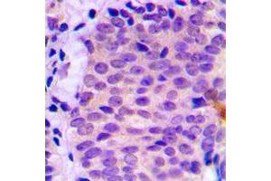 Immunohistochemical analysis of ATG4C staining in human prostate cancer formalin fixed paraffin embedded tissue section.