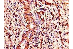 Immunohistochemistry of paraffin-embedded human gastric cancer using ABIN7148300 at dilution of 1:100