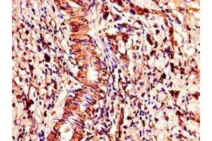 Immunohistochemistry of paraffin-embedded human gastric cancer using ABIN7148300 at dilution of 1:100 (COMMD1 anticorps  (AA 2-190))