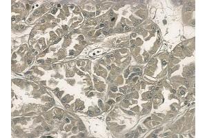 ABIN6256977 and ABIN6275032 at 1/100 staining human renal cell carcinoma by IHC-P. (C1S anticorps  (C-Term))