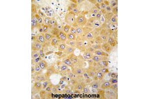 Formalin-fixed and paraffin-embedded human hepatocarcinomareacted with APH1A polyclonal antibody , which was peroxidase-conjugated to the secondary antibody, followed by AEC staining. (APH1A anticorps  (N-Term))