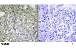 Immunohistochemistry analysis of paraffin-embedded human breast carcinoma tissue using ADRA1D polyclonal antibody . (ADRA1D anticorps)