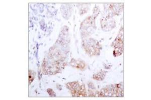 Immunohistochemical analysis of paraffin-embedded human breast carcinoma tissue using Raf-1 (Ab-259) antibody (E021006). (RAF1 anticorps)