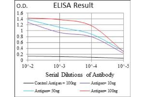 Immunohistochemical analysis of paraffin-embedded bladder cancer tissues using ZFP42 antibody with DAB staining. (ZFP42 anticorps  (AA 249-310))