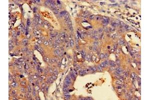 Immunohistochemistry of paraffin-embedded human colon cancer using ABIN7160778 at dilution of 1:100 (NMI anticorps  (AA 62-202))