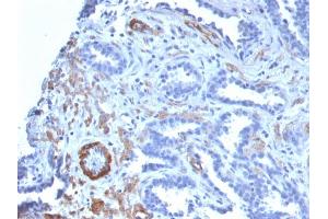 Formalin-fixed, paraffin-embedded human Prostate Carcinoma stained with SM-MHC Recombinant Rabbit Monoclonal Antibody (MYH11/2303R).