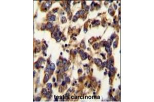 BSCL2 Antibody (N-term) (ABIN654071 and ABIN2843967) immunohistochemistry analysis in formalin fixed and paraffin embedded human testis carcinoma followed by peroxidase conjugation of the secondary antibody and DAB staining.
