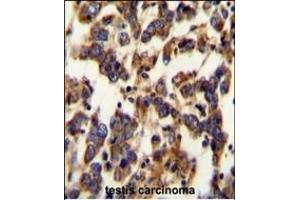 BSCL2 Antibody (N-term) (ABIN654071 and ABIN2843967) immunohistochemistry analysis in formalin fixed and paraffin embedded human testis carcinoma followed by peroxidase conjugation of the secondary antibody and DAB staining. (BSCL2 anticorps  (N-Term))