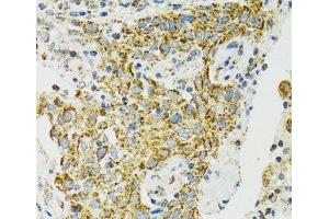Immunohistochemistry of paraffin-embedded Human lung cancer using HSPA9 Polyclonal Antibody at dilution of 1:100 (40x lens).