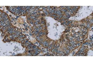 Immunohistochemistry of paraffin-embedded Human colon cancer using NDUFA5 Polyclonal Antibody at dilution of 1:60 (NDUFA5 anticorps)