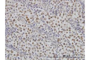 Immunoperoxidase of monoclonal antibody to MAP2K3 on formalin-fixed paraffin-embedded human dysgerminoma.