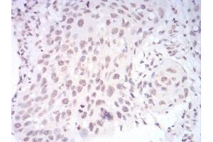 Immunohistochemical analysis of paraffin-embedded esophageal cancer tissues using PAX6 mouse mAb with DAB staining.