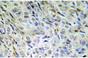 Immunohistochemistry (IHC) analyzes of p-beta-catenin (pSer33/pSer37/pThr41) antibody in paraffin-embedded human lung adenocarcinoma tissue. (CTNNB1 anticorps  (pSer33, pSer37, pThr41))