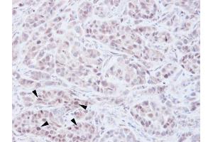 IHC-P Image Immunohistochemical analysis of paraffin-embedded A549 xenograft, using NSD2, antibody at 1:100 dilution. (WHSC1 anticorps  (N-Term))