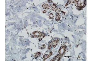 Immunoperoxidase of monoclonal antibody to MAP4K4 on formalin-fixed paraffin-embedded human breast cancer.