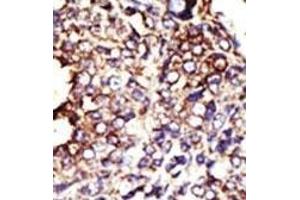 Formalin-fixed and paraffin-embedded human cancer tissue reacted with the primary antibody, which was peroxidase-conjugated to the secondary antibody, followed by DAB staining.