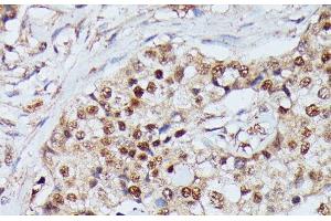 Immunohistochemistry of paraffin-embedded Human mammary cancer using IGHMBP2 Polyclonal Antibody at dilution of 1:100 (40x lens).