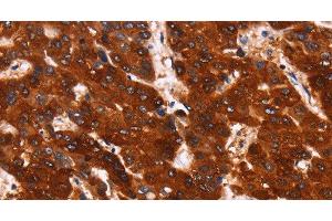 Immunohistochemistry of paraffin-embedded Human liver cancer using GPR124 Polyclonal Antibody at dilution of 1:40 (GPR124 anticorps)