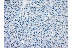 Immunohistochemical staining of paraffin-embedded Adenocarcinoma of colon tissue using anti-BUB1Bmouse monoclonal antibody. (BUB1B anticorps)