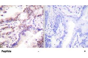 Immunohistochemistry analysis of paraffin-embedded human lung carcinoma tissue using RBBP8 polyclonal antibody . (Retinoblastoma Binding Protein 8 anticorps)