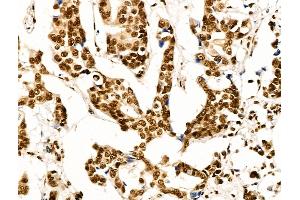 ABIN7094736 and ABIN7098787 at 1/100 staining Human breast cancer by IHC-P. (OVOL2 anticorps  (Internal Region))