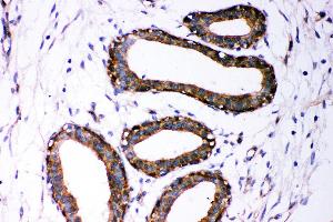 Anti- Dicer antibody, IHC(P) IHC(P): Human Mammary Cancer Tissue (DICER1 anticorps  (AA 1-195))