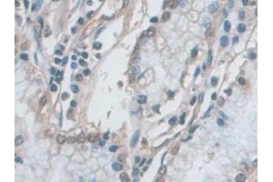 Detection of ERK1 in Human Stomach cancer Tissue using Polyclonal Antibody to Extracellular Signal Regulated Kinase 1 (ERK1)