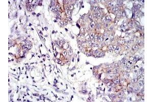 Immunohistochemical analysis of paraffin-embedded stomach cancer tissues using JUP mouse mAb with DAB staining.