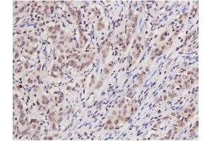 ABIN6267354 at 1/200 staining Human ganstric cancer tissue sections by IHC-P.