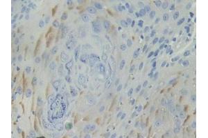IHC-P analysis of Human Skin cancer Tissue, with DAB staining. (BCAM anticorps  (AA 32-257))