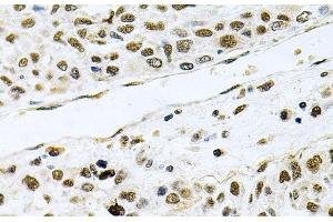 Immunohistochemistry of paraffin-embedded Human lung cancer using MCL1 Polyclonal Antibody at dilution of 1:100 (40x lens). (MCL-1 anticorps)
