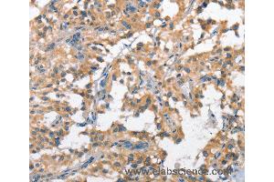 Immunohistochemistry of Human cervical cancer using SCARB1 Polyclonal Antibody at dilution of 1:60 (SCARB1 anticorps)