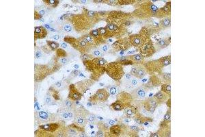 Immunohistochemical analysis of HAGH staining in human liver cancer formalin fixed paraffin embedded tissue section. (HAGH anticorps)